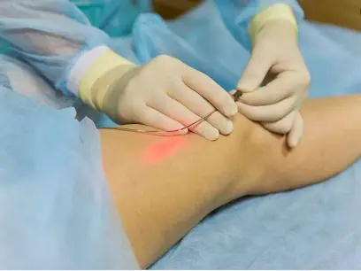 Dr Oukebdane Sid Ahmed Angiologie Phlébologie Laser Varices
